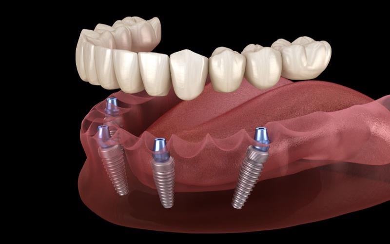 The Healing Process After a Tooth Implant What You Should Expect